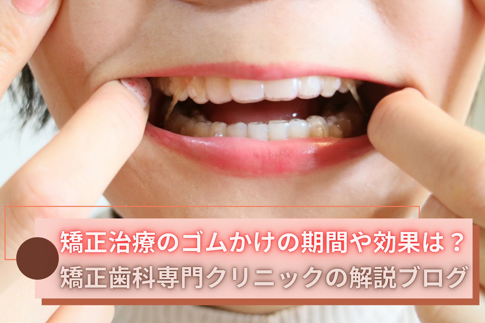 歯 列 矯正 ゴム かけ