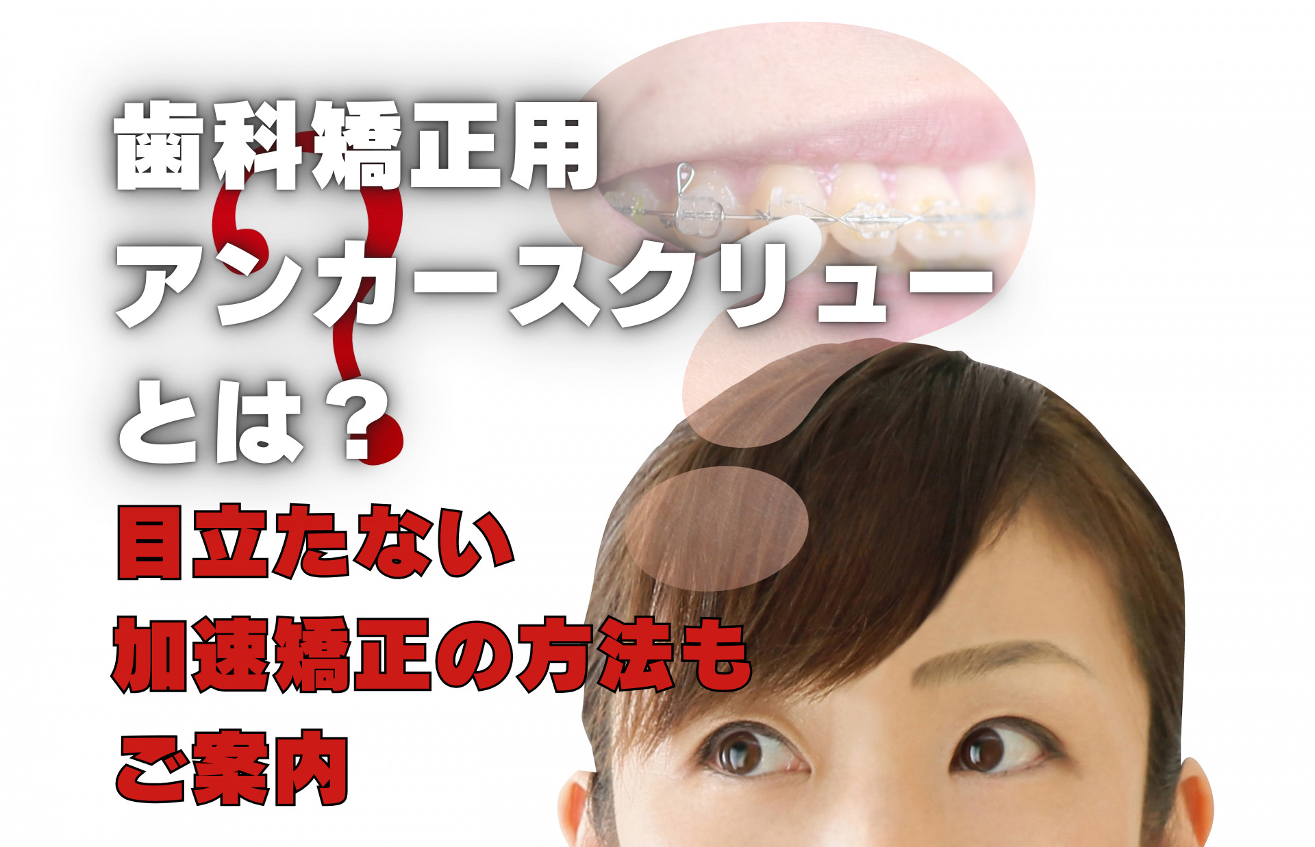 歯科矯正用アンカースクリューとは？目立たない加速矯正の方法もご案内